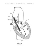 MEDICAL DEVICES AND DELIVERY SYSTEMS FOR DELIVERING MEDICAL DEVICES diagram and image