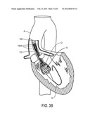 MEDICAL DEVICES AND DELIVERY SYSTEMS FOR DELIVERING MEDICAL DEVICES diagram and image