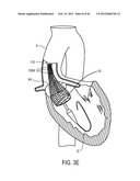 MEDICAL DEVICES AND DELIVERY SYSTEMS FOR DELIVERING MEDICAL DEVICES diagram and image