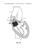 MEDICAL DEVICES AND DELIVERY SYSTEMS FOR DELIVERING MEDICAL DEVICES diagram and image