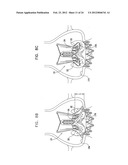 Valve Prosthesis Fixation Techniques Using Sandwiching diagram and image