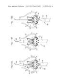 Valve Prosthesis Fixation Techniques Using Sandwiching diagram and image