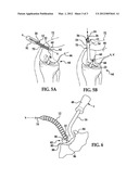 Cartilage Repair System With Flexible Trephine diagram and image
