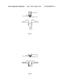 GASTROINTESTINAL DEVICE diagram and image