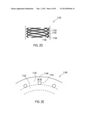  SHIELDED IMPLANTABLE MEDICAL LEAD WITH REDUCED TORSIONAL STIFFNESS diagram and image