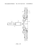 PROSTHESIS FOR REDUCING INTRA-CARDIAC PRESSURE HAVING AN EMBOLIC FILTER diagram and image