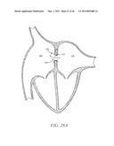 PROSTHESIS FOR REDUCING INTRA-CARDIAC PRESSURE HAVING AN EMBOLIC FILTER diagram and image