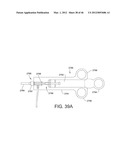 PROSTHESIS FOR REDUCING INTRA-CARDIAC PRESSURE HAVING AN EMBOLIC FILTER diagram and image