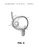 Anti-Refluxive and Trigone Sparing Internal Ureteral Stent diagram and image