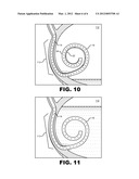 Anti-Refluxive and Trigone Sparing Internal Ureteral Stent diagram and image