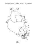 CONDUIT DEVICE FOR USE WITH A VENTRICULAR ASSIST DEVICE diagram and image