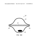 SITE MARKER VISIBLE UNDER MULTIPLE MODALITIES diagram and image