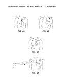 APPARATUS AND METHOD FOR CATHETER NAVIGATION USING ENDOVASCULAR ENERGY     MAPPING diagram and image