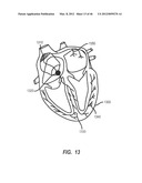 APPARATUS AND METHOD FOR CATHETER NAVIGATION USING ENDOVASCULAR ENERGY     MAPPING diagram and image