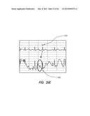 APPARATUS AND METHOD FOR CATHETER NAVIGATION USING ENDOVASCULAR ENERGY     MAPPING diagram and image