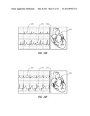 APPARATUS AND METHOD FOR CATHETER NAVIGATION USING ENDOVASCULAR ENERGY     MAPPING diagram and image