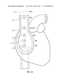 APPARATUS AND METHOD FOR CATHETER NAVIGATION USING ENDOVASCULAR ENERGY     MAPPING diagram and image