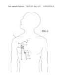 INTRAVENOUS CATHETER ANCHORING DEVICE diagram and image