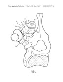 BONE FIXING SYSTEM AND METHOD OF USE diagram and image