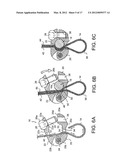 BONE FIXING SYSTEM AND METHOD OF USE diagram and image