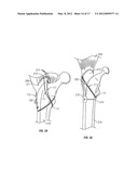 BONE FIXING SYSTEM AND METHOD OF USE diagram and image