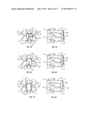 BONE FIXING SYSTEM AND METHOD OF USE diagram and image