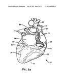 Implantable Micro-Generator Devices with Optimized Configuration, Methods     of Use, Systems and Kits Therefor diagram and image