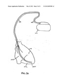 Implantable Micro-Generator Devices with Optimized Configuration, Methods     of Use, Systems and Kits Therefor diagram and image