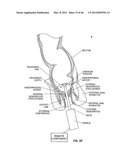 CLOSURE DEVICE AND METHOD diagram and image