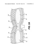 DEVICE AND METHOD FOR TREATMENT OF INCISION OR HERNIA diagram and image