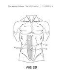 DEVICE AND METHOD FOR TREATMENT OF INCISION OR HERNIA diagram and image