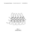 PEDICLE SCREW EXTENSION ALIGNMENT diagram and image