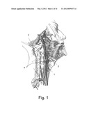 Endovascular Electrostimulation Near a Carotid Bifurcation in Treating     Cerebrovascular Conditions diagram and image