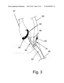 Endovascular Electrostimulation Near a Carotid Bifurcation in Treating     Cerebrovascular Conditions diagram and image