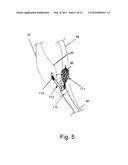 Endovascular Electrostimulation Near a Carotid Bifurcation in Treating     Cerebrovascular Conditions diagram and image