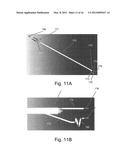 Endovascular Electrostimulation Near a Carotid Bifurcation in Treating     Cerebrovascular Conditions diagram and image