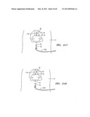 COLLAPSIBLE/EXPANDABLE TUBULAR ELECTRODE LEADS diagram and image