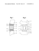 PROSTHESIS FOR PARTIAL REPLACEMENT OF A VERTEBRAL BODY diagram and image