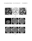 EXACT LOCAL COMPUTED TOMOGRAPHY BASED ON COMPRESSIVE SAMPLING diagram and image