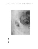 CATHETER WITH IMAGING ASSEMBLY diagram and image