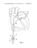 APPARATUS FOR SAFE PERFORMANCE OF TRANSSEPTAL TECHNIQUE AND PLACEMENT AND     POSITIONING OF AN ABLATION CATHETER diagram and image