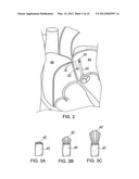 APPARATUS FOR SAFE PERFORMANCE OF TRANSSEPTAL TECHNIQUE AND PLACEMENT AND     POSITIONING OF AN ABLATION CATHETER diagram and image