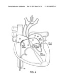 APPARATUS FOR SAFE PERFORMANCE OF TRANSSEPTAL TECHNIQUE AND PLACEMENT AND     POSITIONING OF AN ABLATION CATHETER diagram and image