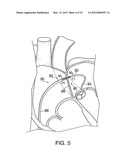 APPARATUS FOR SAFE PERFORMANCE OF TRANSSEPTAL TECHNIQUE AND PLACEMENT AND     POSITIONING OF AN ABLATION CATHETER diagram and image