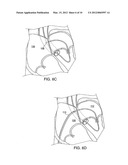 APPARATUS FOR SAFE PERFORMANCE OF TRANSSEPTAL TECHNIQUE AND PLACEMENT AND     POSITIONING OF AN ABLATION CATHETER diagram and image