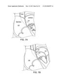 APPARATUS FOR SAFE PERFORMANCE OF TRANSSEPTAL TECHNIQUE AND PLACEMENT AND     POSITIONING OF AN ABLATION CATHETER diagram and image