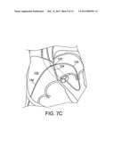 APPARATUS FOR SAFE PERFORMANCE OF TRANSSEPTAL TECHNIQUE AND PLACEMENT AND     POSITIONING OF AN ABLATION CATHETER diagram and image