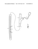 SYSTEMS AND METHODS FOR TREATING A HOLLOW ANATOMICAL STRUCTURE diagram and image