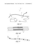 SYSTEMS AND METHODS FOR TREATING A HOLLOW ANATOMICAL STRUCTURE diagram and image