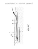 SYSTEMS AND METHODS FOR TREATING A HOLLOW ANATOMICAL STRUCTURE diagram and image